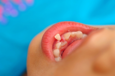Pediatric Dental Surgery: What Parents Need to Know, Pt. 2